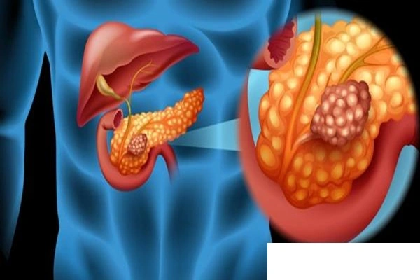 Breaking the Bottleneck in Early Diagnosis of Pancreatic Cancer