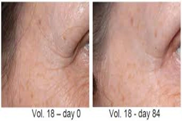 Palmitoyl Tripeptide-5 Powder